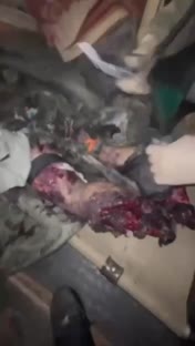Oprasi tulang kaki retak halus